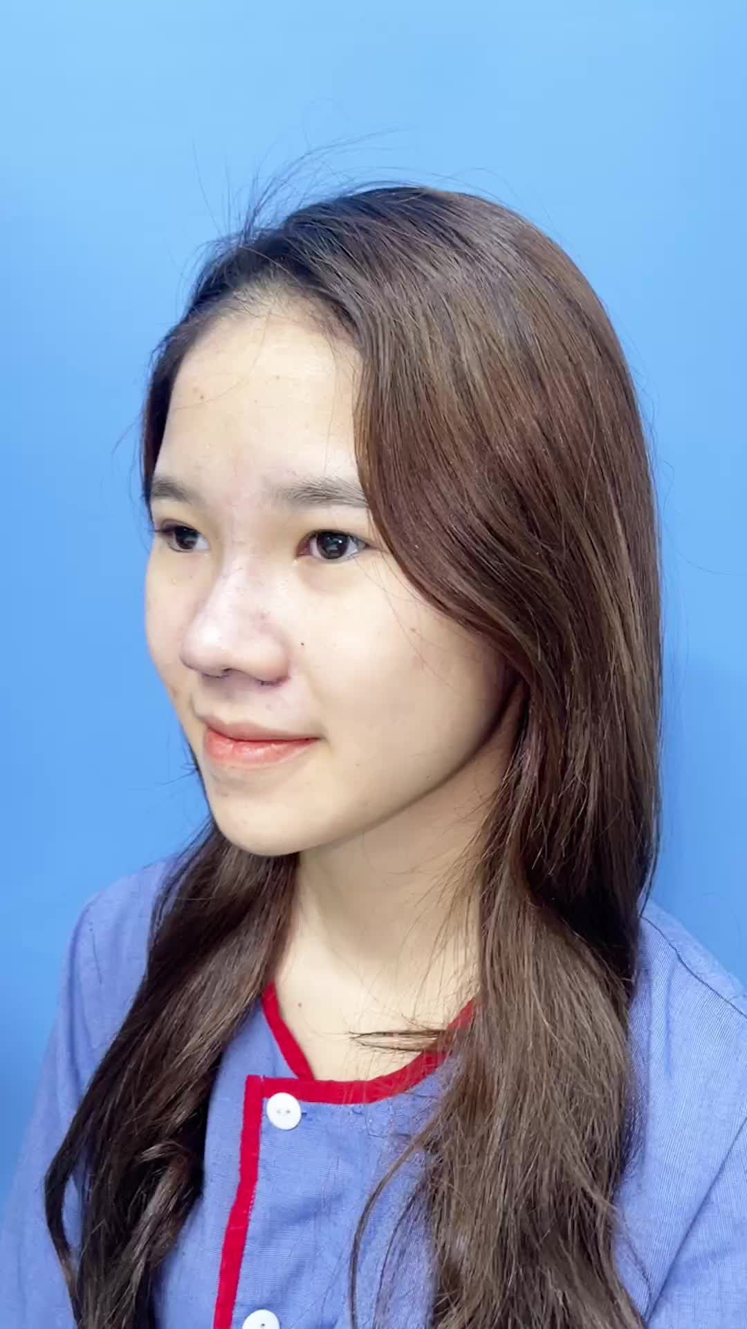 Kết quả nâng mũi 6D Sugiform của bạn nữ sáng nay đây ạ!!